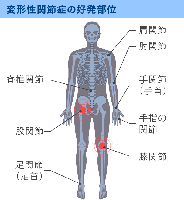 関節症と運動機能低下の原因